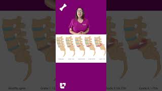 Cathy explains what spondylolisthesis is what causes it and the treatment  LevelUpRN [upl. by Etteyafal]