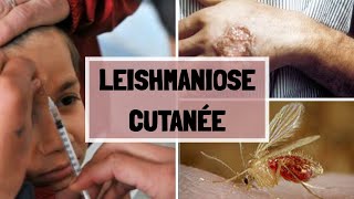 LA LEISHMANIOSE CUTANNÉ  CAUSES  SYPMTOMES  COMPLICATIONS  TRAITEMENT [upl. by Goines]