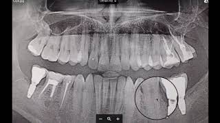 schmerzen unterkiefer links  ursache auf dem panoramaröntgen [upl. by Kemeny]