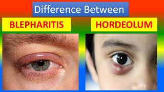 Difference Between Blepharitis and Hordeolum [upl. by Lyram666]