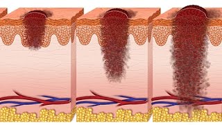 Comment définiton un ulcère de jambe [upl. by Araik21]