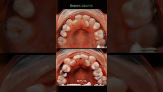 Braces Transformation dentist orthodontist braces dental [upl. by Namolos]