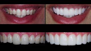 Porcelain Dental Veneer Placement San Antonio [upl. by Kenna]