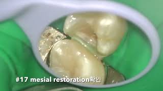 26 partial pulpectomy amp 27 proximal occlusal resin restoration [upl. by Halden]