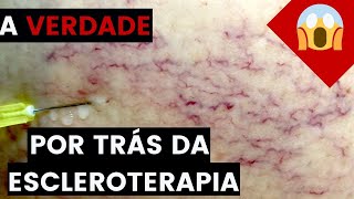 A VERDADE por trás da ESCLEROTERAPIA aplicação de VARIZES Não faça se você NÃO souber isso [upl. by Jillene]