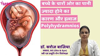 प्रेगनेंसी में बच्चे के चारों ओर पानी ज्यादा होने का कारण और इलाज Polyhydramnios Dr Saroj Bajiya [upl. by Aisenet]