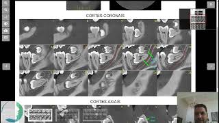 MatBorTorCas  Exodontia dos Sisos com Piezo e biomaterial [upl. by Cesar]