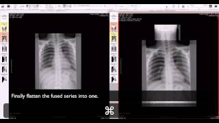 OsiriX  manual fusion of two series [upl. by Arda827]