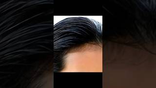 Hair Transplant Me Kitna Paisa Lagta Hai [upl. by Marlen]