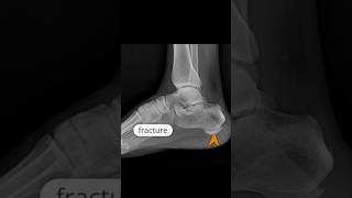 A transverse incomplete nondisplaced fracture of the calcaneus xray [upl. by Adiesirb]