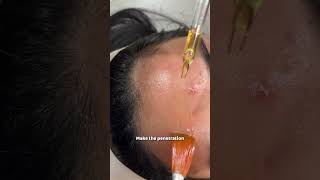 Why Should you consider Dermapen 4 Treatment  Dr Sarin [upl. by Assirrak768]