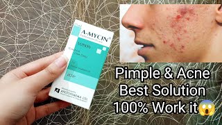 AMycin Lotion For Acne or Pimpleব্রণ দূর করার উপায় pimpleproblem acnetreatmentpimple popper [upl. by Trefler]