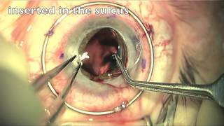 Corneal Transplant  Cataract Surgery [upl. by Ahtabat]