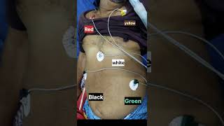 Colour code of electrode placement in chest region [upl. by Marla405]