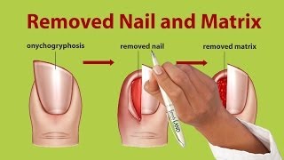 Nail Removal Treatment for Onychogryphosis [upl. by Ecadnarb]