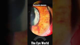 Neovascular glaucoma [upl. by Bree324]