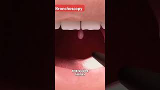 Bronchoscopy mbbsdoctor medicalcollegestudents studentdoctor medicaldegree hospital [upl. by Kiona]