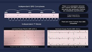 Third Degree Atrioventricular Block ECG [upl. by Aisitel]