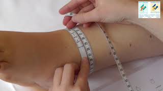 measurement of a leg lymphedema patient [upl. by Neysa667]