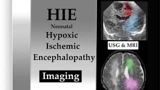 HYPOXIC ISCHEMIC ENCEPHALOPATHY in Preterm amp term neonates l Pathogenesis amp Imaging USG amp MRI l [upl. by Oivaf]