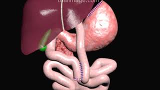 Gastric Bypass Surgery RouxenY Animation by Cal Shipley MD [upl. by Broder]