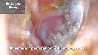 RT EAR OTOMYCOSIS WITH SMALL CENTRAL PERFORATION [upl. by Silvestro371]