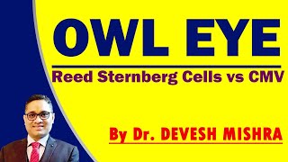 Owl Eye  Reed sternberg cells vs CMV Dr Devesh Mishra [upl. by Aerehs]