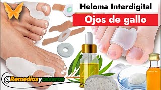 ⚕️💚🦶 Ojo de gallo en el pie ¿Cómo se cura Síntomas Causas y Tratamiento remediosycaseros [upl. by Alcot]