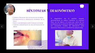 Queilitis Angular  Salud Bucal  4MET5152 [upl. by Panaggio]