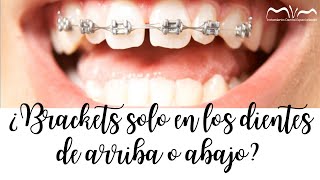 😱 Ortodoncia con pocos brackets Es posible 😱 [upl. by Khalin]