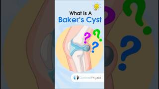 Baker’s Cyst anatomy physiotharapy physicaltherapy bakerscyst kneepain [upl. by William919]