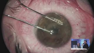 Intrastromal Pockets with FEMTO LDV Z6 in lenticule transplantation in keratoconus by Dr Stodulka [upl. by Troc]