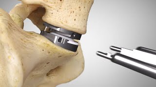 prodisc® L Surgical Technique Animation 2021  Lumbar Total Disc Replacement  Disc Arthroplasty [upl. by Bertrand487]