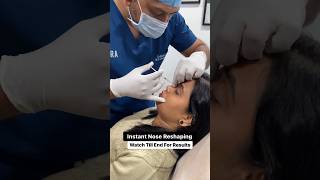 quotTransform Your Nose in Minutes NonSurgical Rhinoplasty Revealquot nonsurgicalrhinoplasty [upl. by Malley]