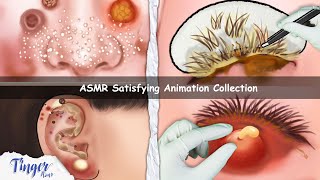 ASMR CARE ANIMATION COLLECTION  Cleaning Big Hole Swollen Ear Dry Eyelid Sebum Extrusion [upl. by Assir]