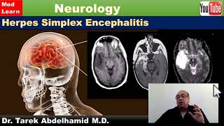 Herpes Simplex Encephalitis HSE [upl. by Nahtan]