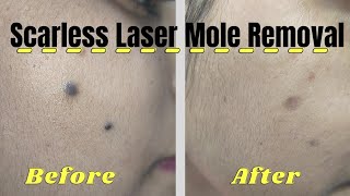 Laser mole removal Scarless mole removal surgery mole removal in Ranchi best mole removal mole [upl. by Koah275]