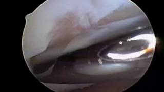 Chondroplasty  Cartilage Knee Surgery by Dr Steven Struhl [upl. by Akiaki]