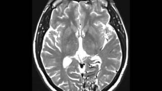 Arteriovenous Malformation [upl. by Aevin]