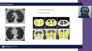 Patient Evaluation for Zephyr Endobronchial Valve Treatment [upl. by Yregerg633]