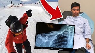 I BROKE MY COLLAR BONE  LIVE FOOTAGE [upl. by Auqenahs]