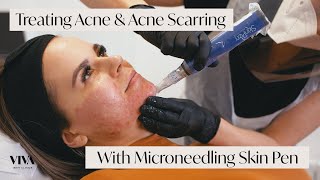 This Is Microneedling for Acne Scarring 🎯 [upl. by Cand]