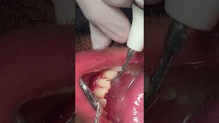 Scaling umairtoothfairy dental shorts viral umairazeem Umairazeem8553 [upl. by Ebehp]