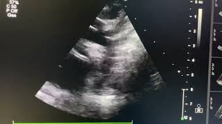 Severe aortic stenosis in case of Neonate￼ [upl. by Crisey]