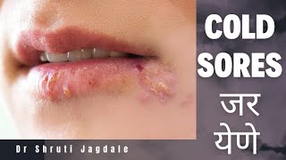 Cold Sores  जर येणे  Ayurvedic Home cure  घरगुति उपाय [upl. by Shantee]