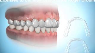 Invisalign Roger Drouin orthodontiste certifié [upl. by Medlin]