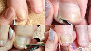 1 Pedicure Tutorial Big Toenail Cleaning Compilation Real Time ✔ [upl. by Liagaba843]