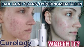 I Tried Curology For PostAcne MarksHyperpigmentation  4 Month Results  Review NOT SPONSORED [upl. by Ahtanaram298]