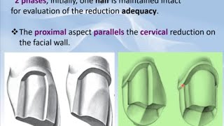 5 Metal Ceramic Crown Preparation StepbyStep بالعربي [upl. by Corty]