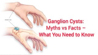 What is a Ganglion Cyst Causes Symptoms and Treatment Explained by a Doctor [upl. by Barbra]